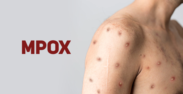 Santa Catarina segue sem casos de Mpox e Saúde Estadual reforça orientações