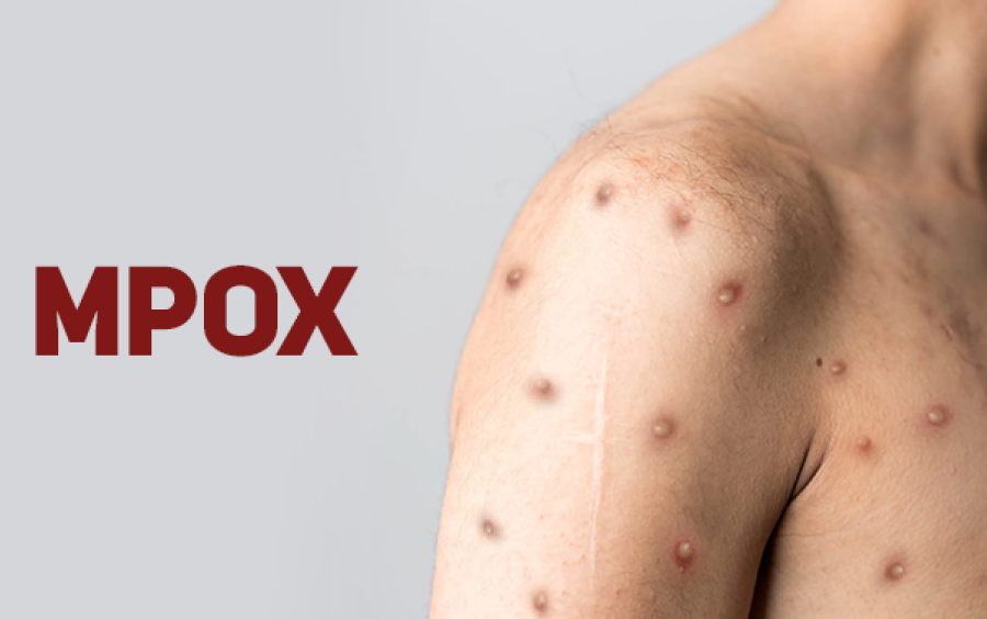 Santa Catarina segue sem casos de Mpox e Saúde Estadual reforça orientações